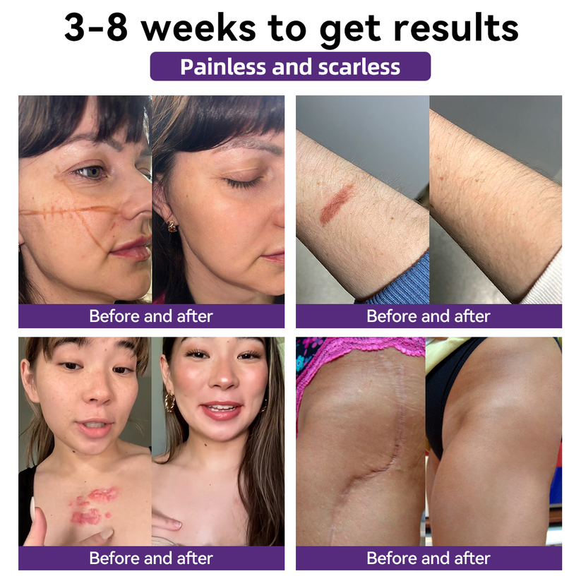 【Limited time discount sale🔥】 Advanced Scar Gel-🏆 Specialized for keloid management🏆