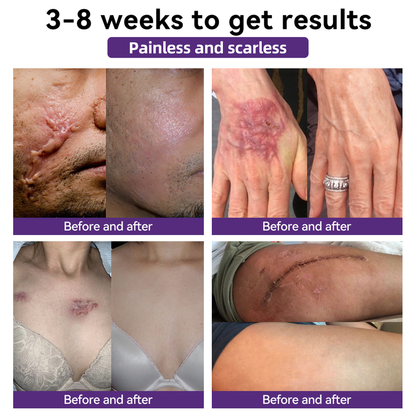 【Limited time discount sale🔥】 Advanced Scar Gel-🏆 Specialized for keloid management🏆