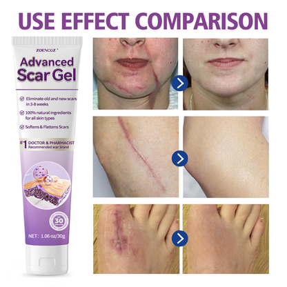 【Limited time discount sale🔥】 Advanced Scar Gel-🏆 Specialized for keloid management🏆