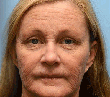 Last Day Promotion 80% OFF - ✨Furzero™ Bee Venom Wrinkle Removal Cream